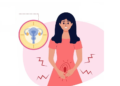Vaginal Discharge