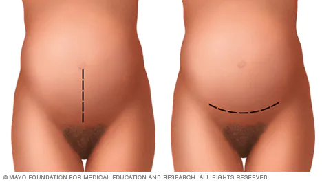 abdominal-CSection