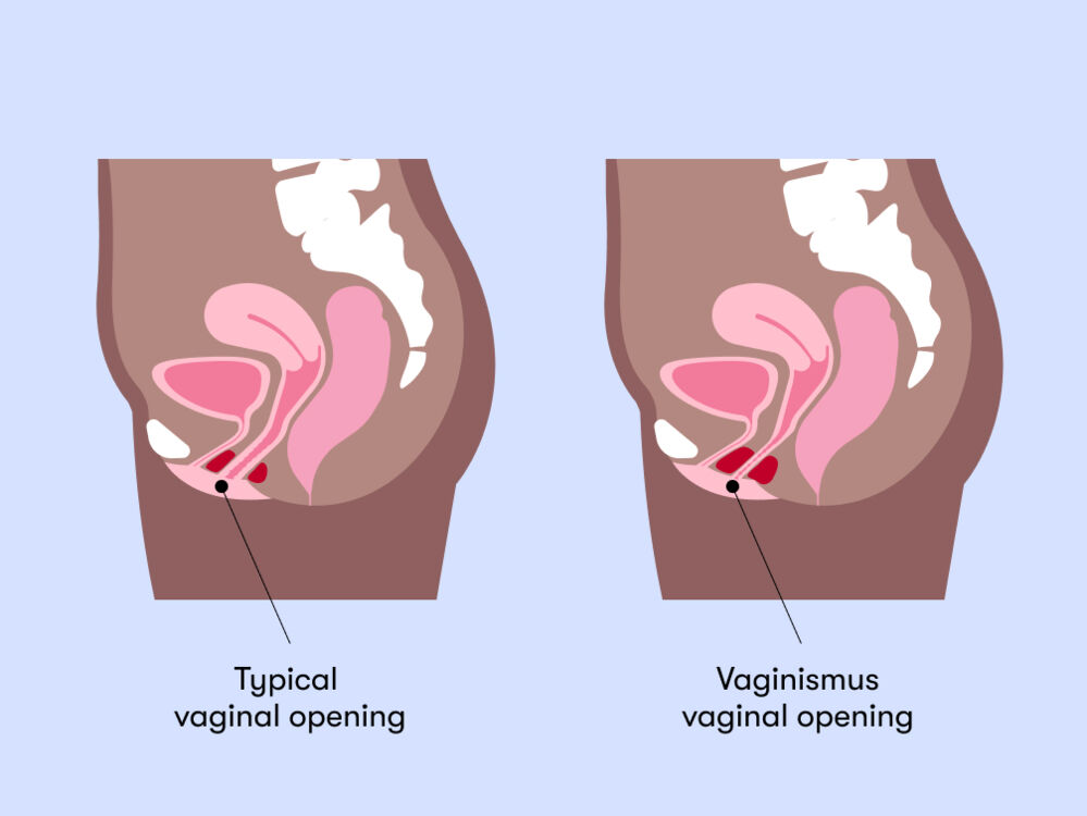 What Does Vaginismus Look Like