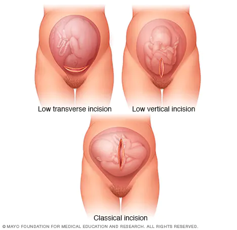 utertine-incision