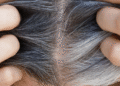 What Causes Gray Hair?