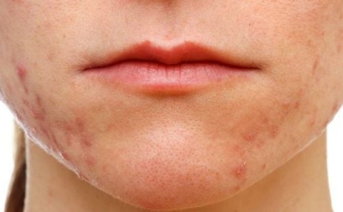 نیاسینامید میتواند مشکلات پوستی مانند چین و چروک، آکنه و... را بهبود بخشد.